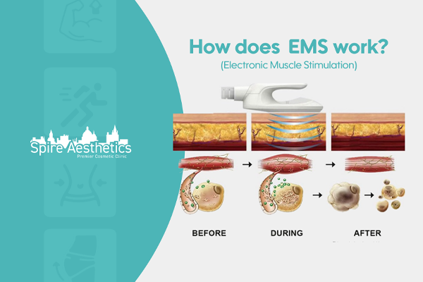 EMS treatment for post pregnancy weight loss treatment Boston