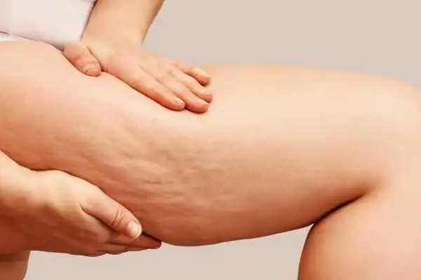 Image of woman showing leg with cellulite Boston