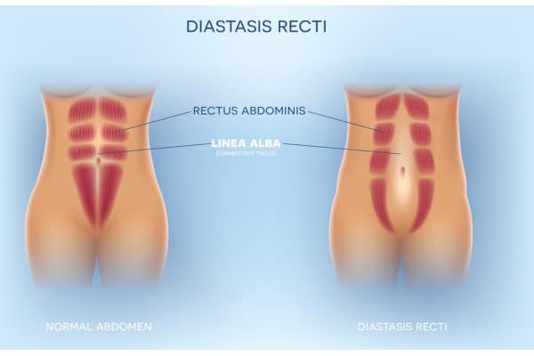 What Non-Surgical Options Are Available for Diastasis Recti Boston?