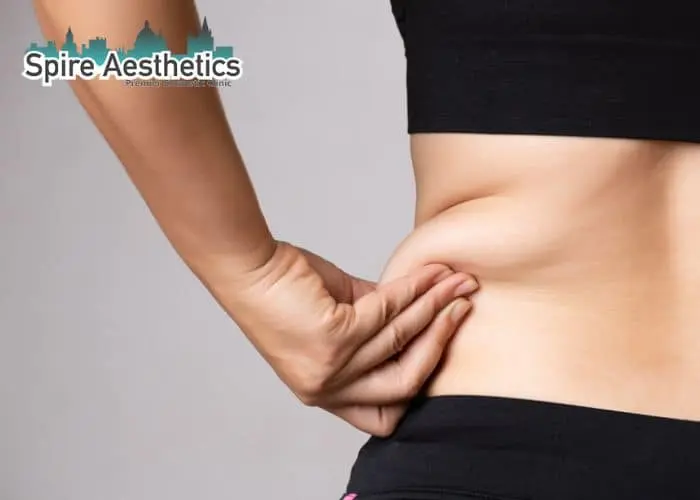 Image of woman pinching fat on their hips Boston. Fat Freezing treatment