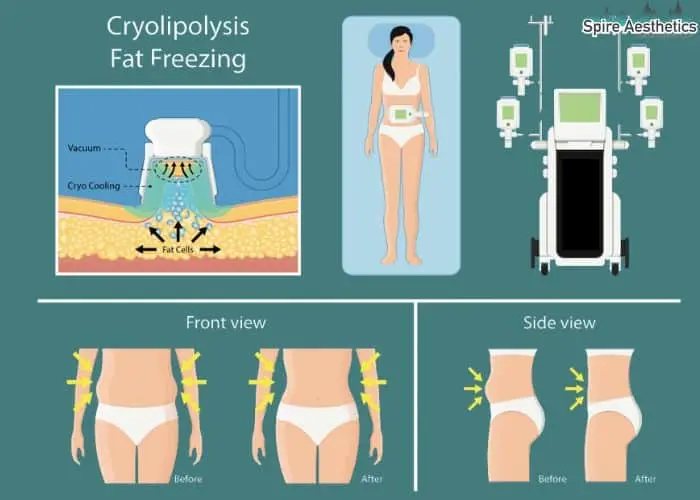 Fat freezing treatment Boston benefits for competitions to remove stubborn fat deposits.