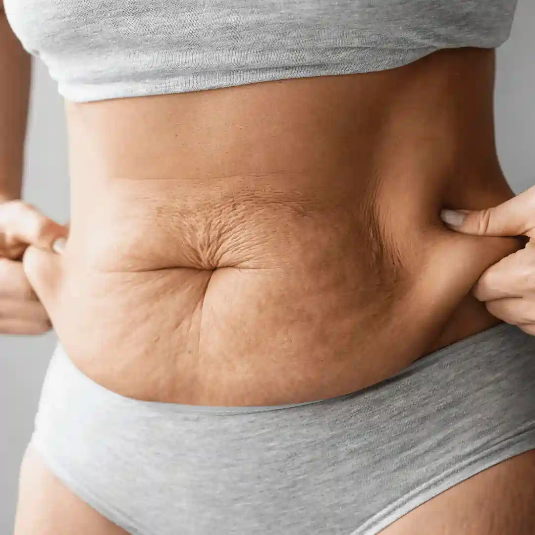 Is It Normal to Have Loose Skin After Pregnancy Boston?