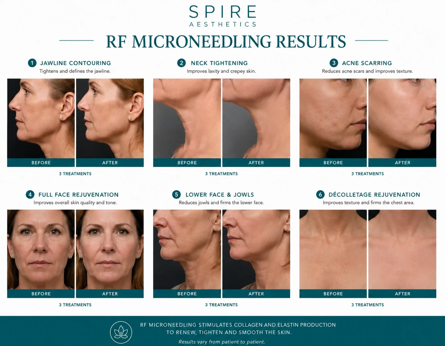 RF Microneedling Skin tightening Boston results