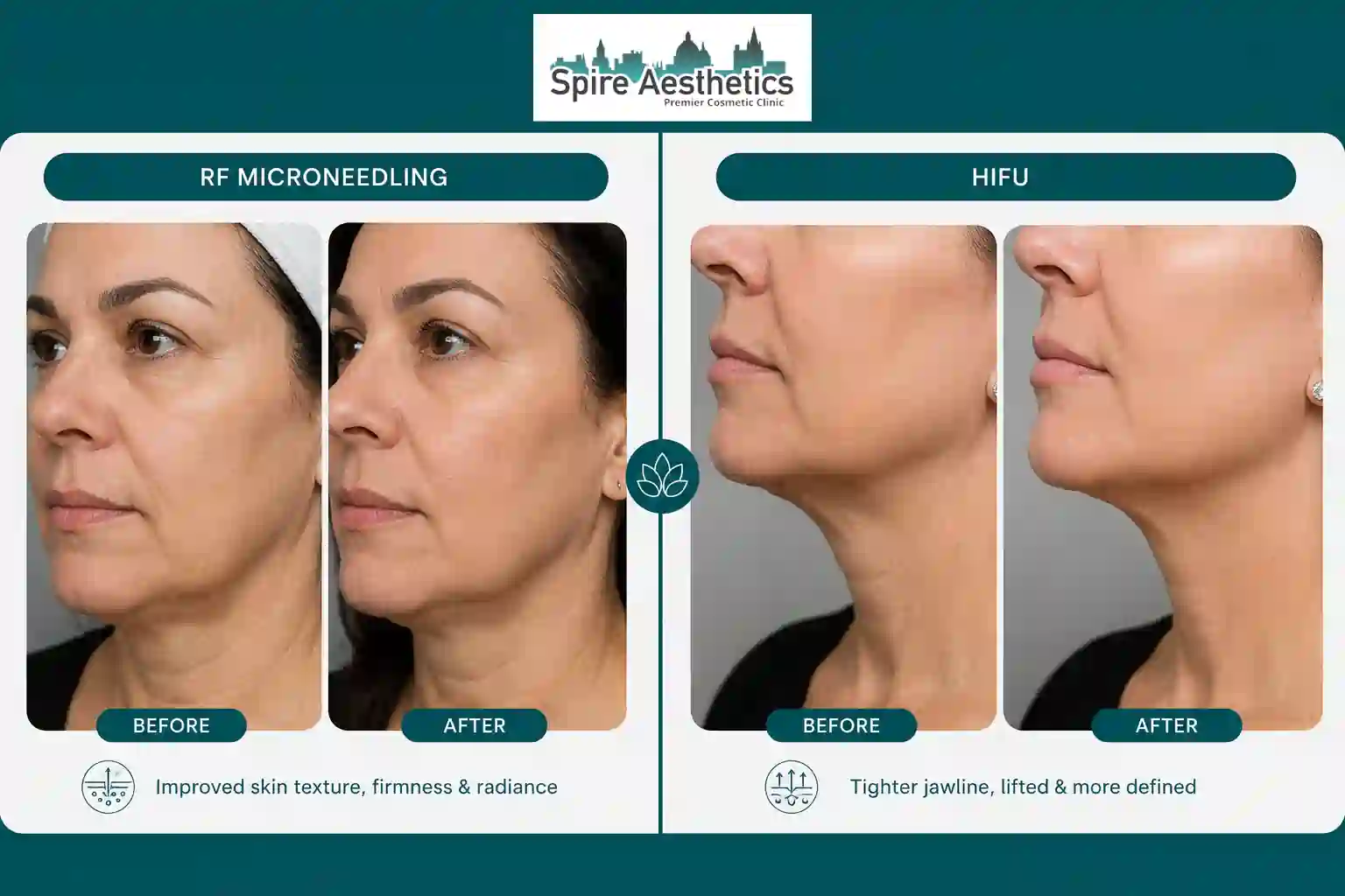 Can RF Microneedling and HIFU Be Combined Boston?