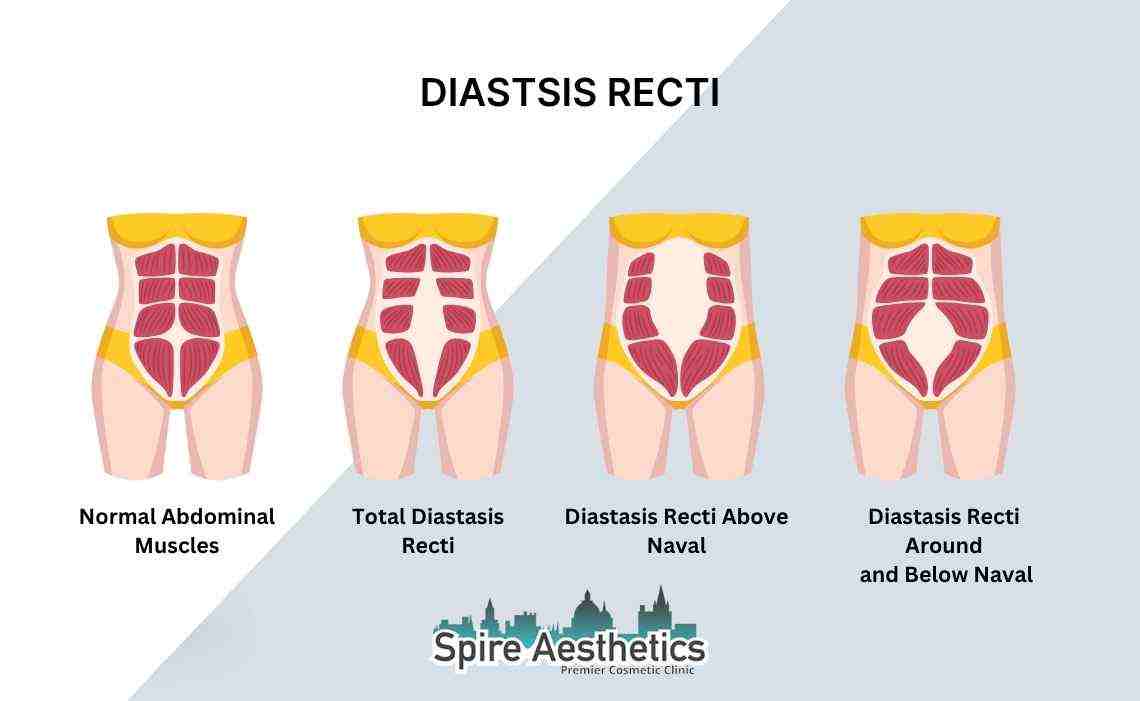 Is Non-Surgical Diastasis Recti Treatment Right for You? Common Concerns Answered Boston